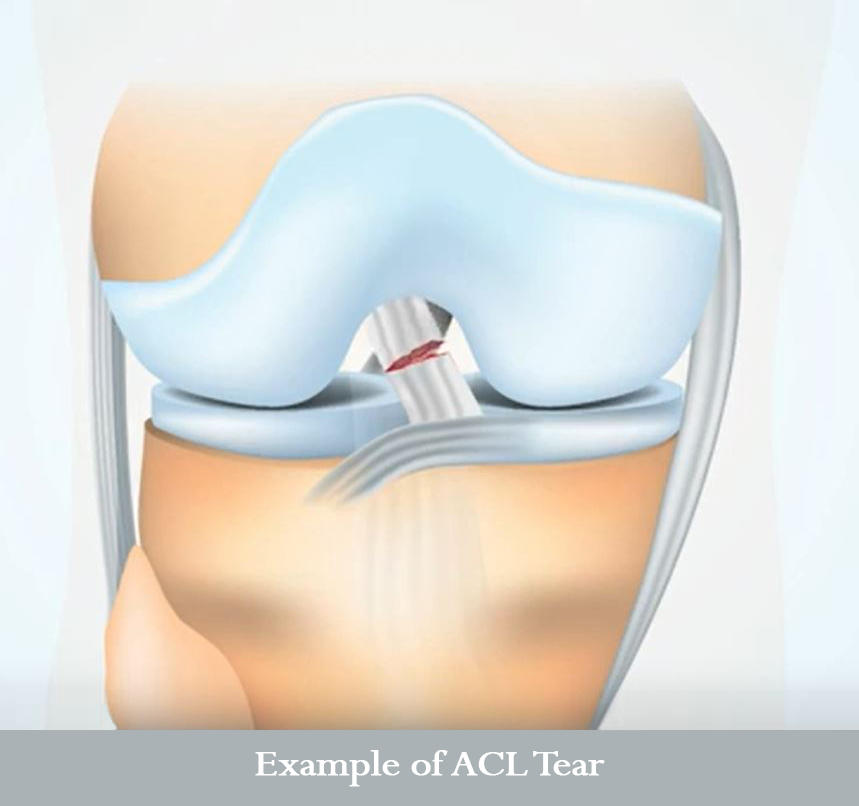 ACL Tear