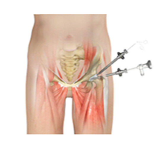 hip arthroscopy