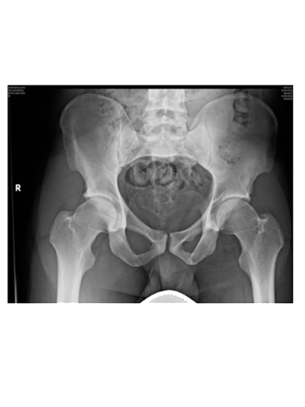 Hip xray