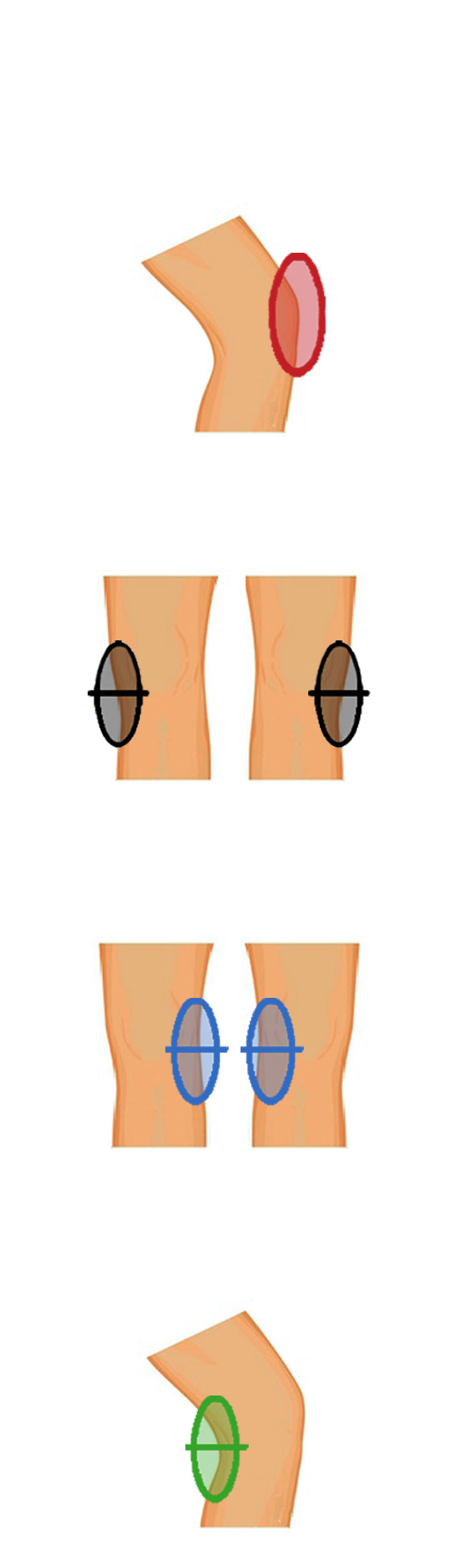 Front and side knee pain zones