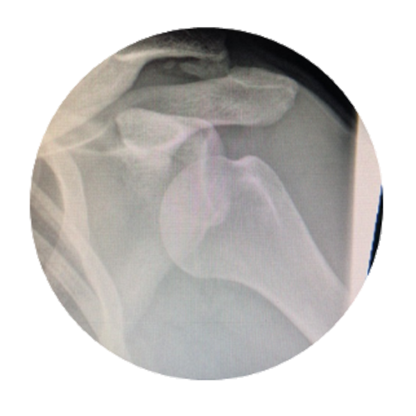 shoulder xray